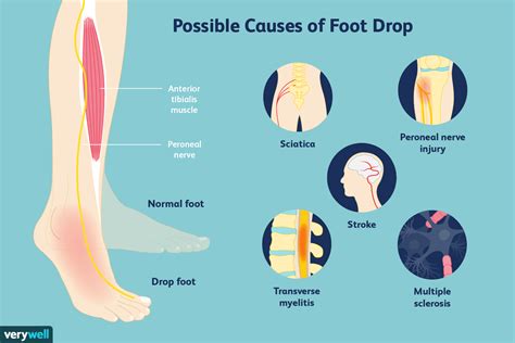 how to treat a foot drop